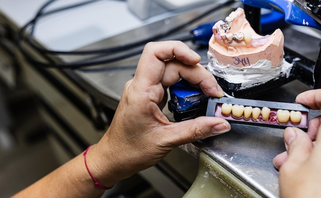Dental Bridges