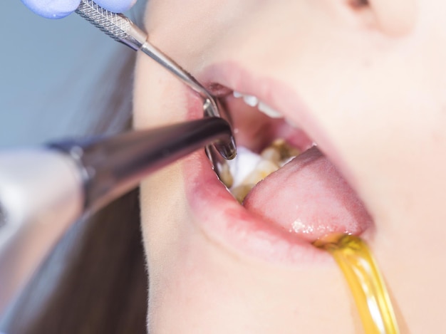 Dental Fillings